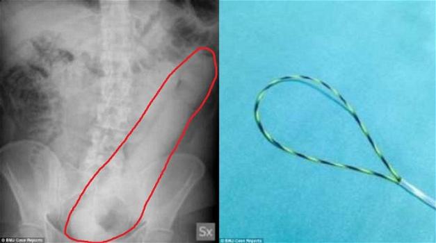 “Aiuto, mi fa male la pancia”: i medici scoprono un dildo di 60 centimetri all’interno di un paziente