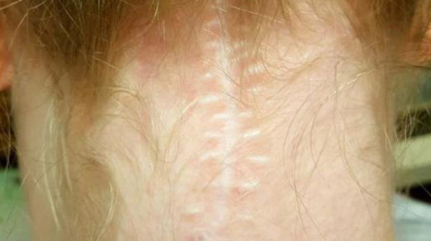 Cicatrice sul collo. Padre chiede aiuto sui social per far superare il disagio alla figlia