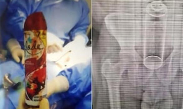 Bomboletta di deodorante nel retto: 40enne incolpa la moglie