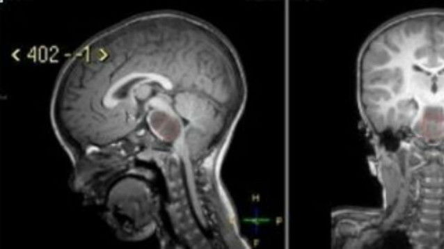 bambino di 3 anni sorride stranamente i medici scoprono che ha un tumore al cervello in fase terminale