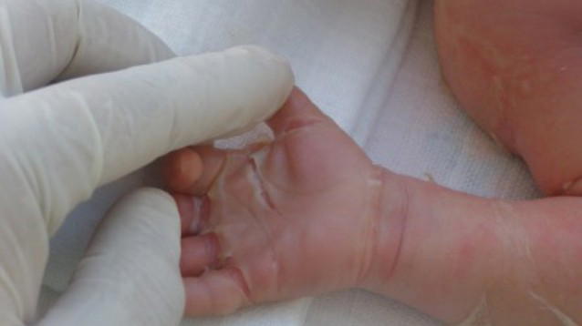 India, nasce con una malattia rara e la madre la rifiuta: non la voglio, è una maledizione