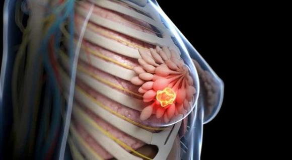 Cancro al seno: scoperti i geni che predicono il rischio di metastasi