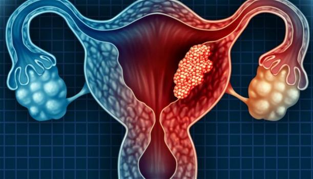 Carcinoma ovarico, la mortalità è in calo ma solo il 65% delle donne fa il test genetico
