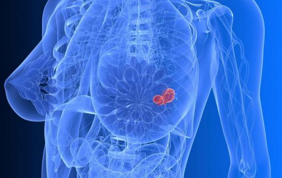 Cancro al seno: scoperti i geni che predicono il rischio di metastasi