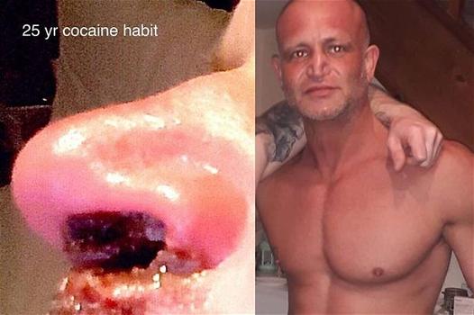 I dottori pensano che abbia un cancro al naso perché gli cade a pezzi ma erano gli effetti di 25 anni di cocaina