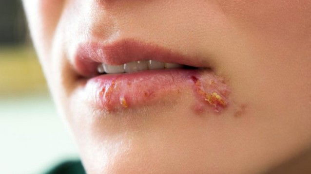 L’Herpes e i rimedi per l’Herpes Labials