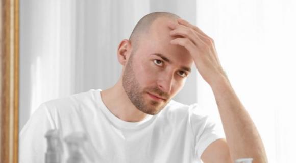 Calvizie, scoperta una cura definitiva: la prima sperimentazione ha avuto successo