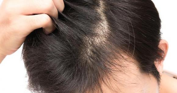 Calvizie, scoperta una cura definitiva: la prima sperimentazione ha avuto successo