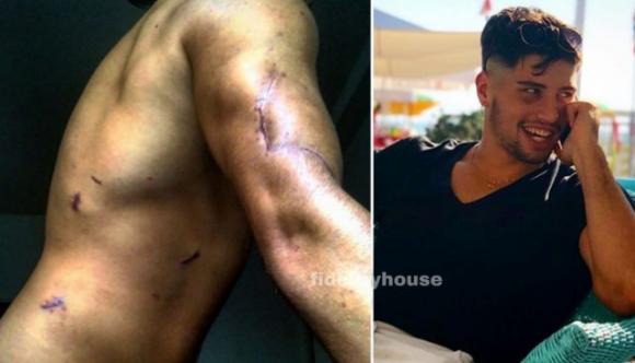 Ad un anno dall’aggressione, Niccolò Bettarini mostra le sue cicatrici: “Tutti noi siamo ferite viventi”