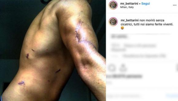 Ad un anno dall’aggressione, Niccolò Bettarini mostra le sue cicatrici: “Tutti noi siamo ferite viventi”
