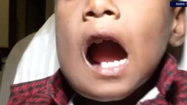 India: medici estraggono 526 denti dalla mascella di un bambino di 7 anni
