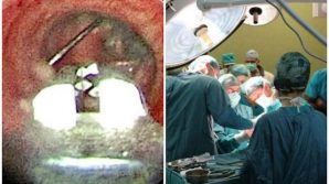 Torino, una bambina ingoia uno spillo: salvata all’Ospedale Infantile Regina Margherita