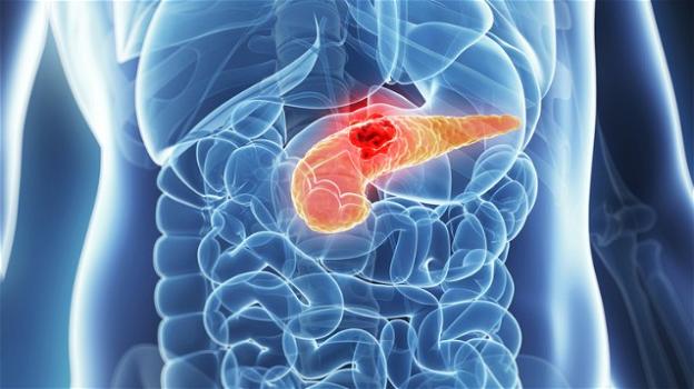 Quello al pancreas è il più subdolo ed aggressivo tra tutti i tumori