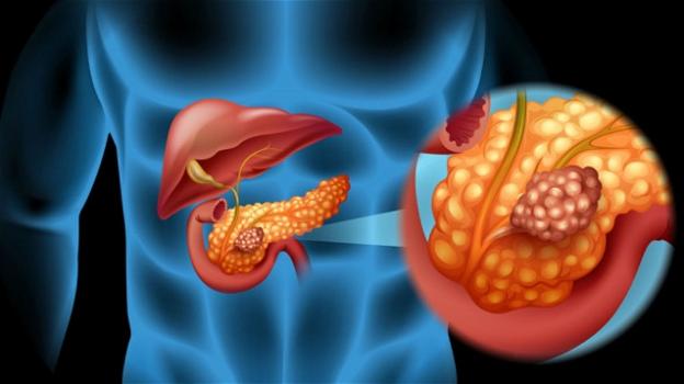 Dal 1990 è aumentata l’incidenza del tumore al colon retto e la mortalità di quello al pancreas