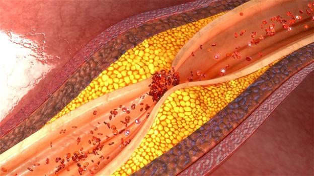 LdlB, il "nuovo" colesterolo cattivo responsabile delle malattie cardiovascolari