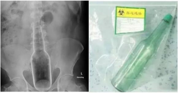 60enne si presenta in ospedale con una bottiglia nel retto: “Avevo un forte prurito”