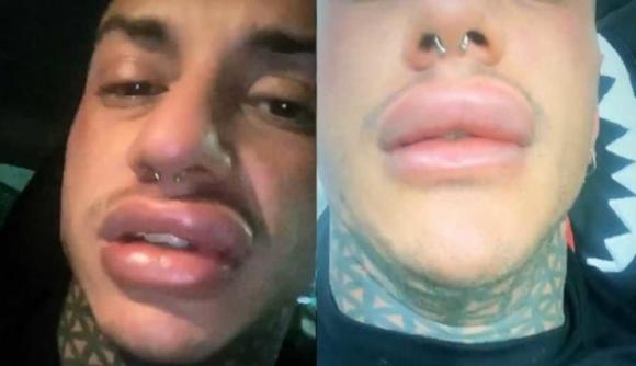 Francesco Chiofalo accusato di aver mentito sulle labbra: spuntano le foto che lo incastrano