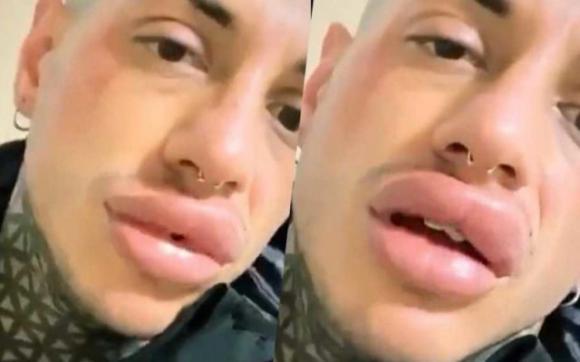 Francesco Chiofalo accusato di aver mentito sulle labbra: spuntano le foto che lo incastrano