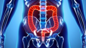 Tumore al colon: ricercatori dell’ISS scoprono l’esistenza di cellule tumorali “dormienti”