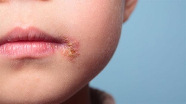 Herpes labiale: bimbo inglese di quattro anni lo avrà per tutta la vita