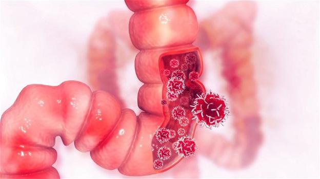 Ricercatori italiani scoprono un ceppo di batteri che blocca lo sviluppo del tumore al colon-retto