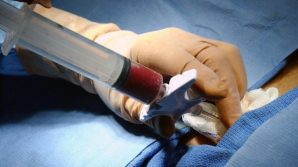 Londra: paziente curato dall’Hiv con un trapianto di midollo