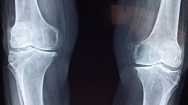Rigenerare le cartilagini danneggiate con un microcerotto