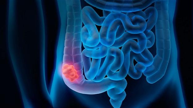 L’immunoterapia allunga la vita nei malati di cancro al colon