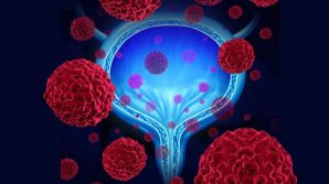 Olaparib per curare il tumore alla prostata