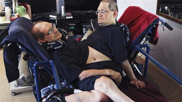 USA. Muoiono a 68 anni i gemelli siamesi più vecchi al mondo, Ronnie e Donnie Galyon