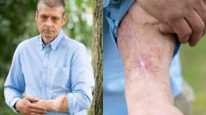 Inghilterra: perde il pene per un’infezione, i medici glielo ricostruiscono sull’avambraccio