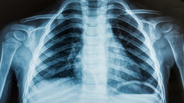 Covid-19, l’ecografia polmonare scova i positivi più efficacemente del tampone