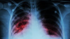 Restrizione calorica controllata per curare e prevenire la tubercolosi