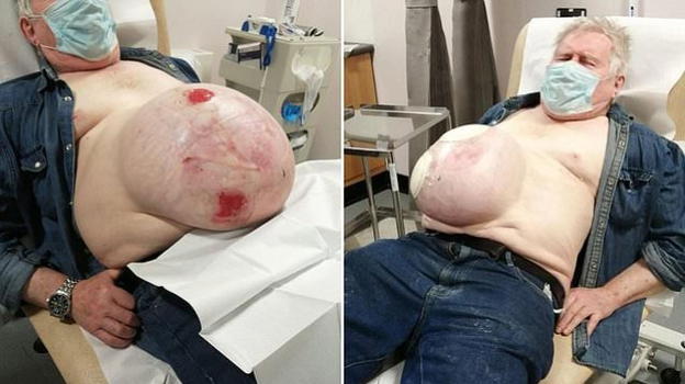 UK: 72enne con ernia gigante sullo stomaco "Intervento saltato per il lockdown e mai recuperato"