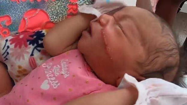 USA: errore durante il cesareo, neonata sfregiata con 13 punti in faccia