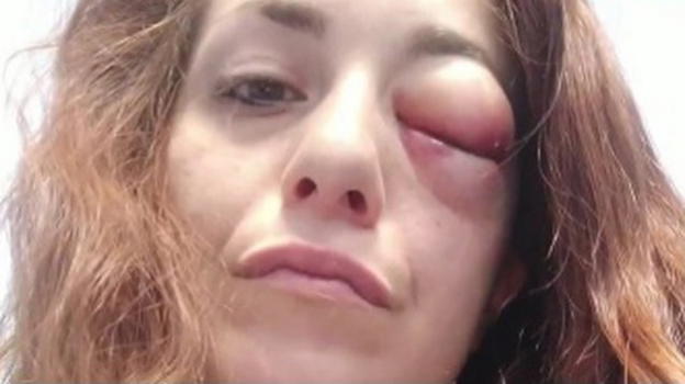 Giuliana Danzè col volto tumefatto: a ridurla così il suo compagno
