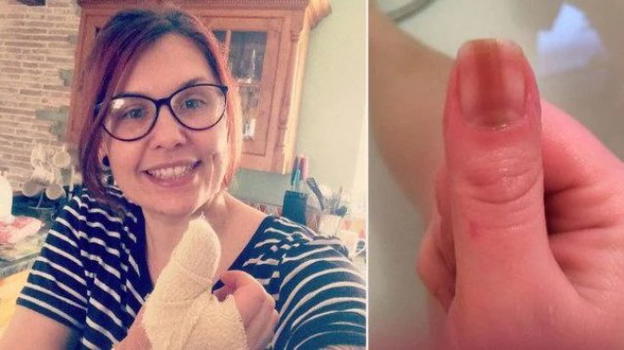 Pensava fosse una riga sull’unghia ma era un tumore: salvata da un articolo online