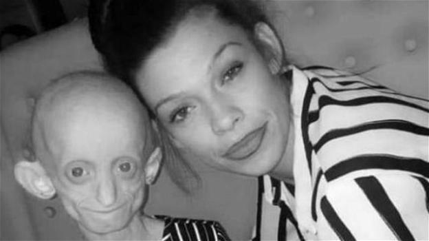 UK: muore ragazza 18enne affetta dalla "malattia di Benjamin Button"