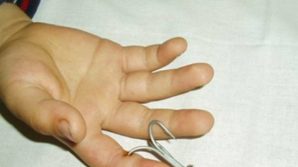 UK, raccoglie alghe in mare e viene trafitta da un amo da pesca alla mano: paura per un bimba