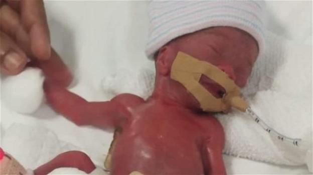 Torna a casa la neonata più piccola al mondo: pesava solo 200 grammi alla nascita