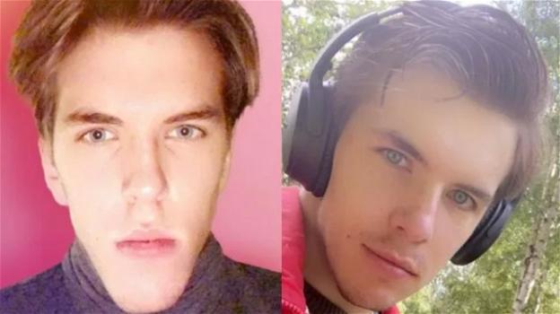 Svezia: 20enne mostra l’incredibile trasformazione dopo l’intervento alla mascella per curare il prognatismo
