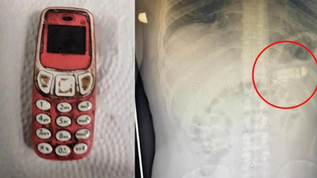 Kosovo, ingoia un mini telefono con tutta la batteria: i medici lo estraggono