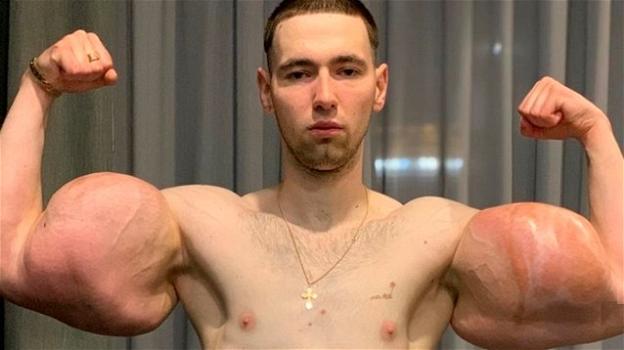 Bodybuilder russo rischia la vita per le sostanze iniettate sui bicipiti per assomigliare a Superman