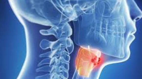 Cancro alla gola e alla laringe in aumento: i sintomi a cui fare attenzione