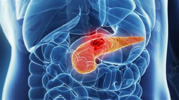 Il tumore al pancreas è uno dei più letali, i 5 principali sintomi e cosa fare per evitarlo