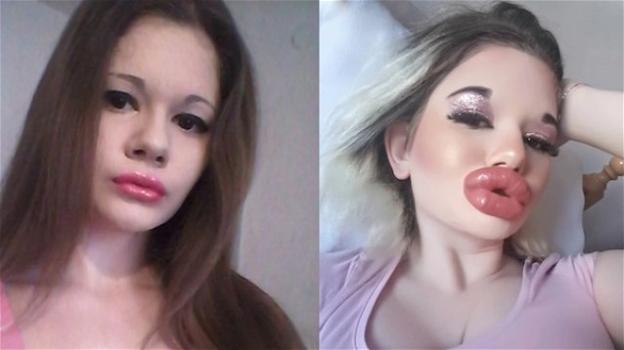 24enne con le labbra più grandi al mondo pronta alla 27esima iniezione: "Voglio somigliare ad una Bratz"