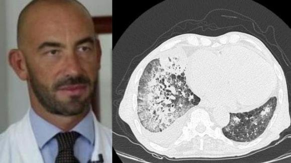 Bassetti condivide su Facebook una foto choc: i polmoni dei non vaccinati colpiti da Covid
