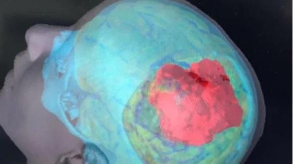 Bari: 14 ore di intervento per rimuovere un tumore e ricostruire il cranio di un bimbo di 7 anni