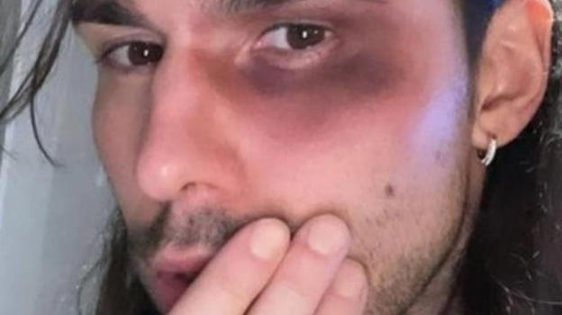 Parigi, Luca Onestini aggredito in un bar per aver difeso la fidanzata