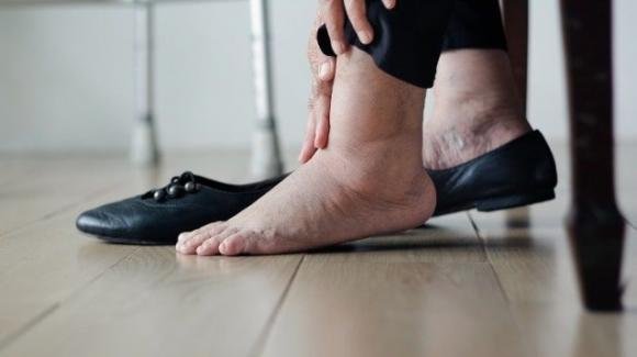 Infarto: attenzione all’aspetto dei vostri piedi